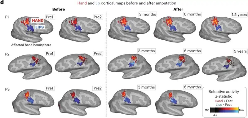 4 cerebros de 3 pacientes